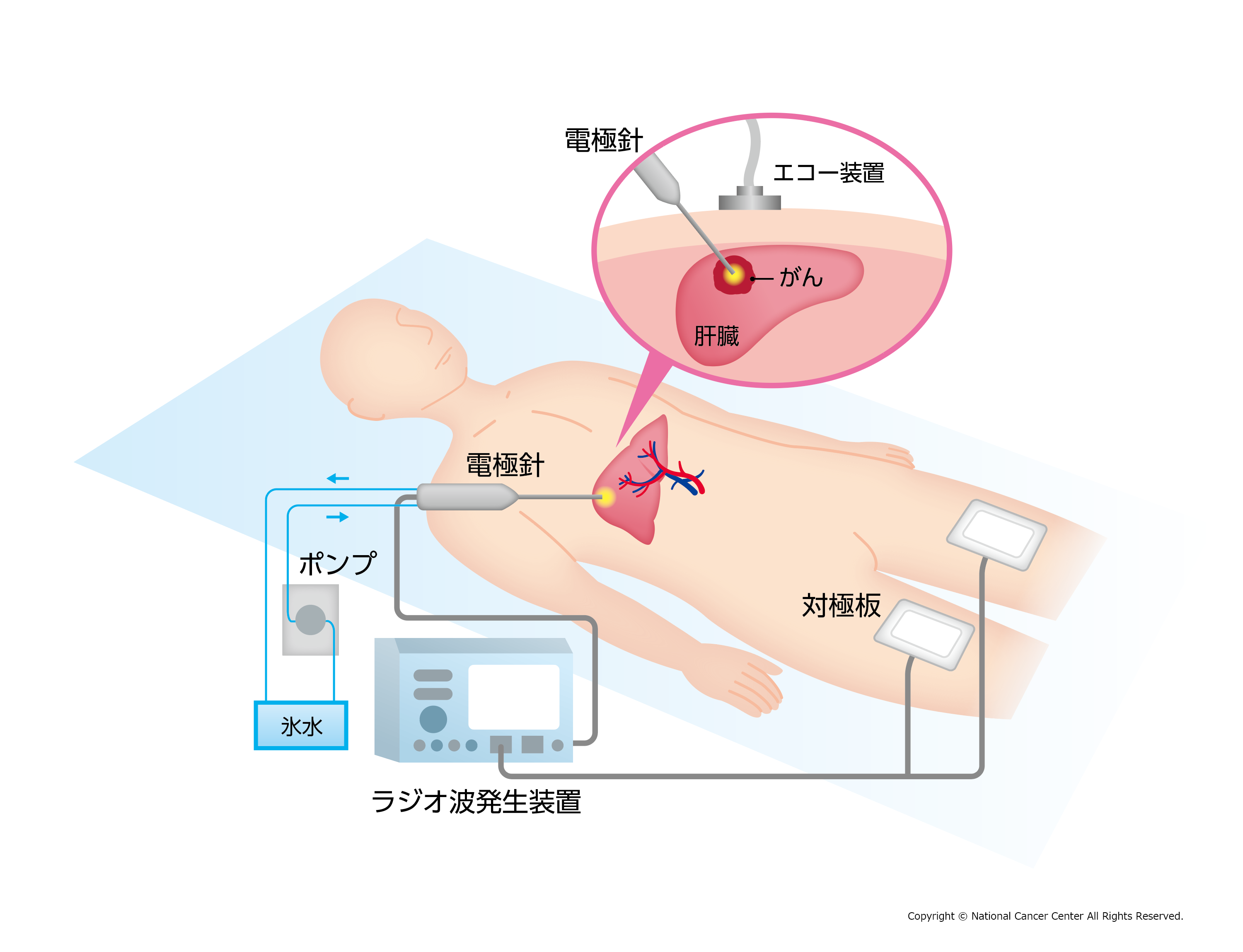 ラジオ波焼灼療法（RFA）